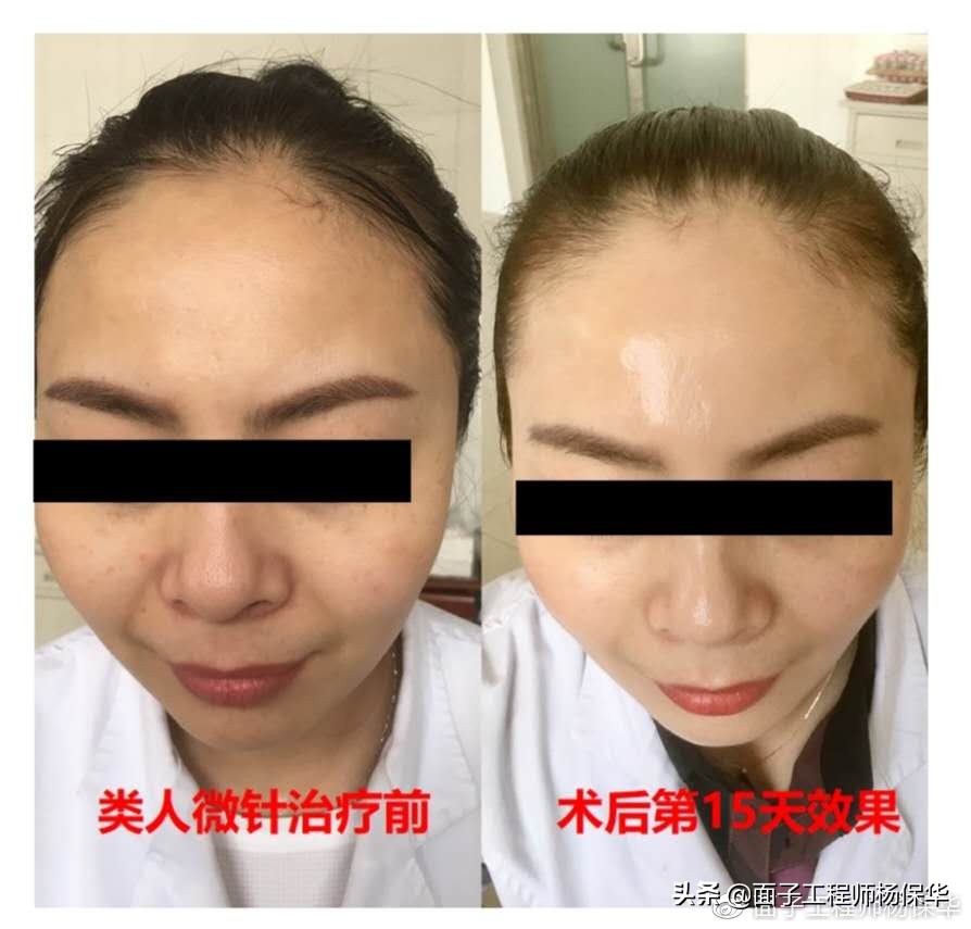 怎么正确补充胶原蛋白,怎样补充胶原蛋白