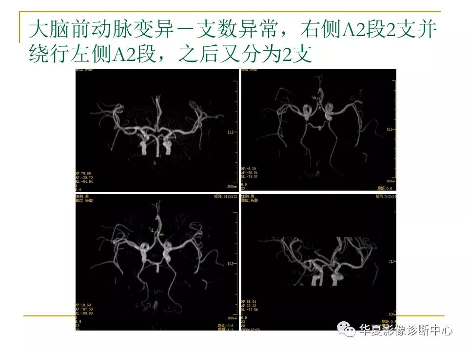 中国人脑立体定向mri应用解剖图谱,脑mri示意图