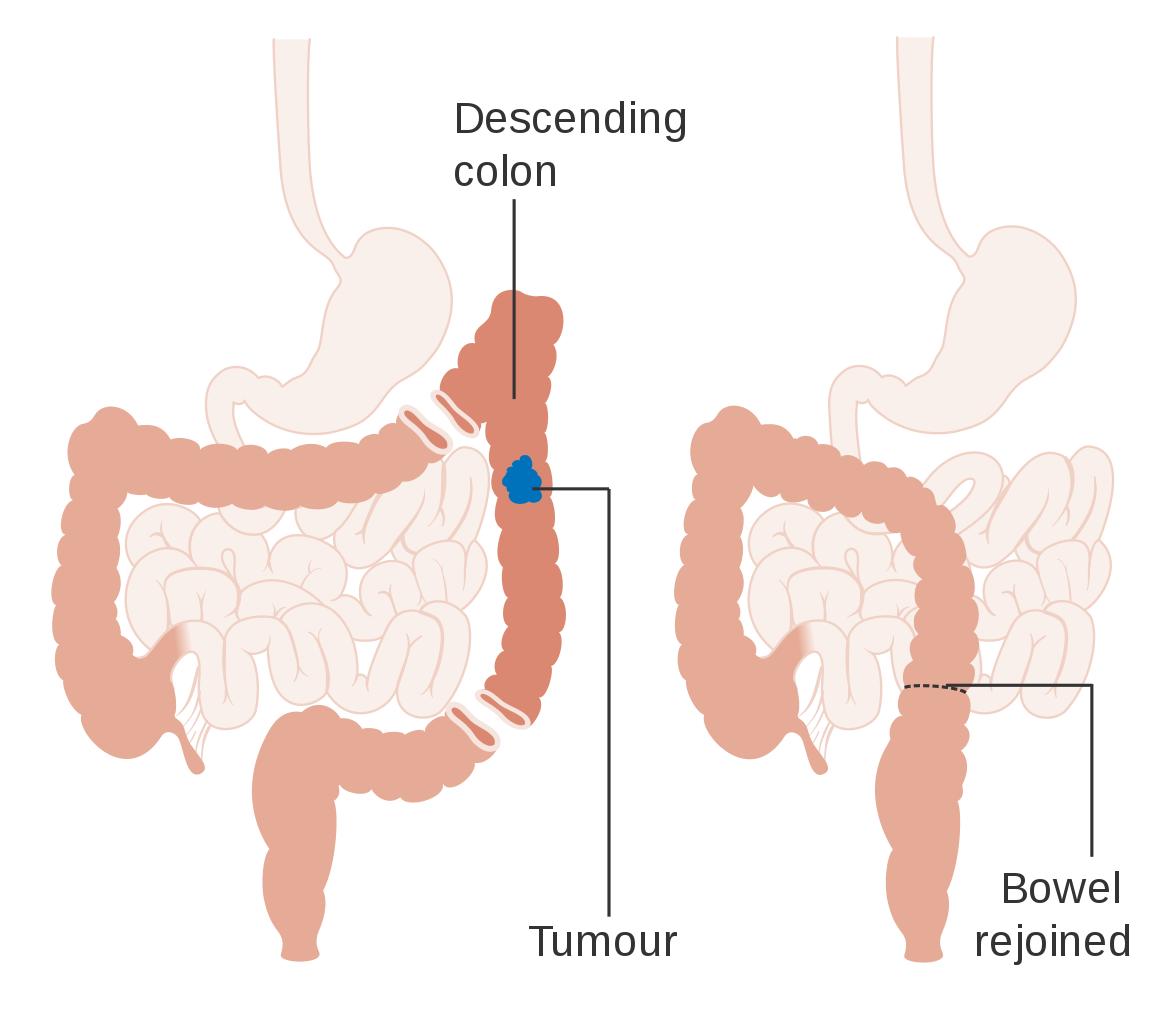 肠癌引起肠梗阻最佳中医治疗方法,肠癌引起的肠梗阻如何治疗