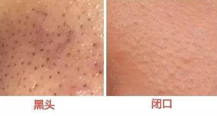 去黑头完了如何修复,去黑头省钱攻略