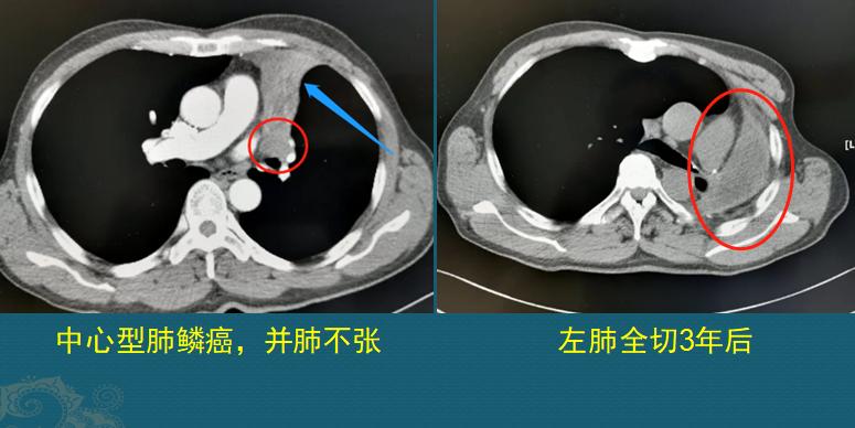 怎样确定肺鳞癌生长速度过快,肺鳞癌肿瘤生长速度