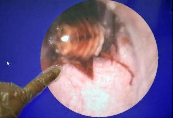 给三岁小男孩掏耳朵,3岁宝宝总是反复用手掏嗓子