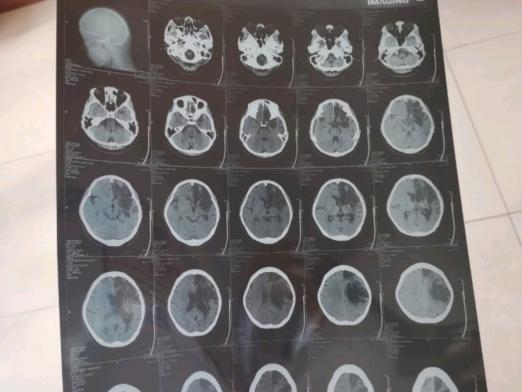 脑梗偏瘫失语怎么可以说话,脑梗失语康复操完整版