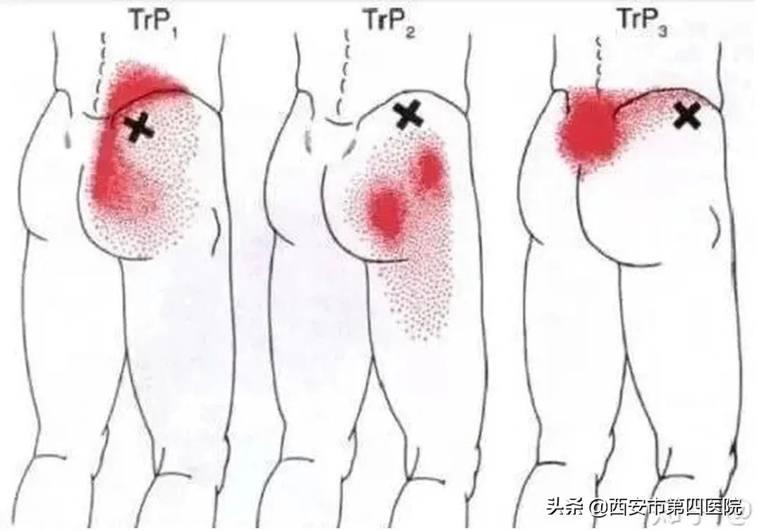 坐月子后腰疼腿疼怎么回事,产后月子里腰椎疼得厉害怎么办