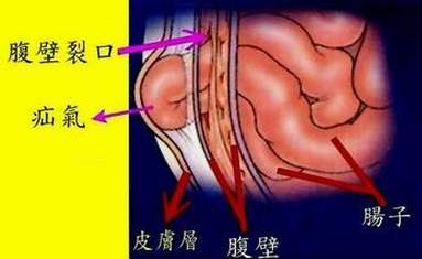 儿科专家：宝宝*处私**出现小疙瘩？这种病可能影响生殖器官发育