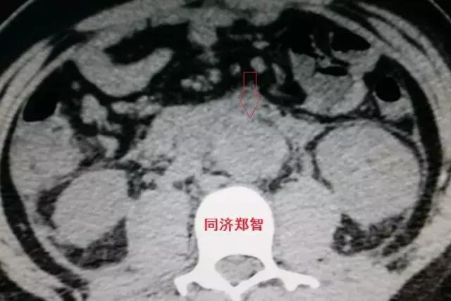 磁共振可以替代cta检查主动脉夹层,超声心动图联合cta诊断主动脉夹层