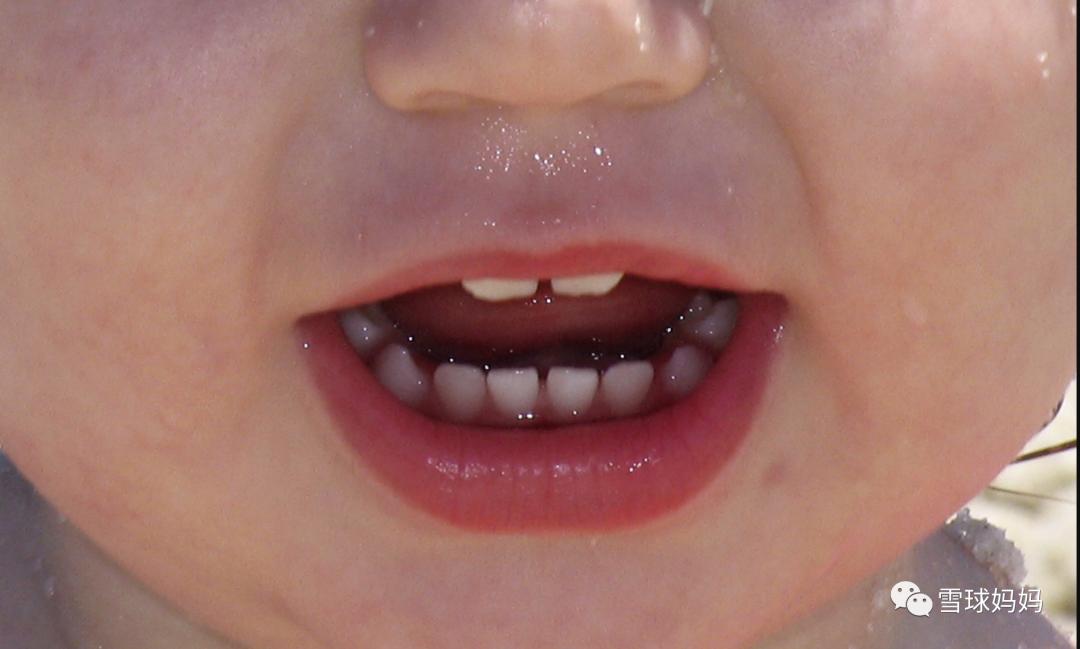 三岁孩子做根管治疗不配合,三岁小孩可以做根管治疗吗