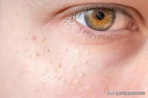 粟丘疹汗管瘤扁平疣区别,粟丘疹和汗管瘤区别