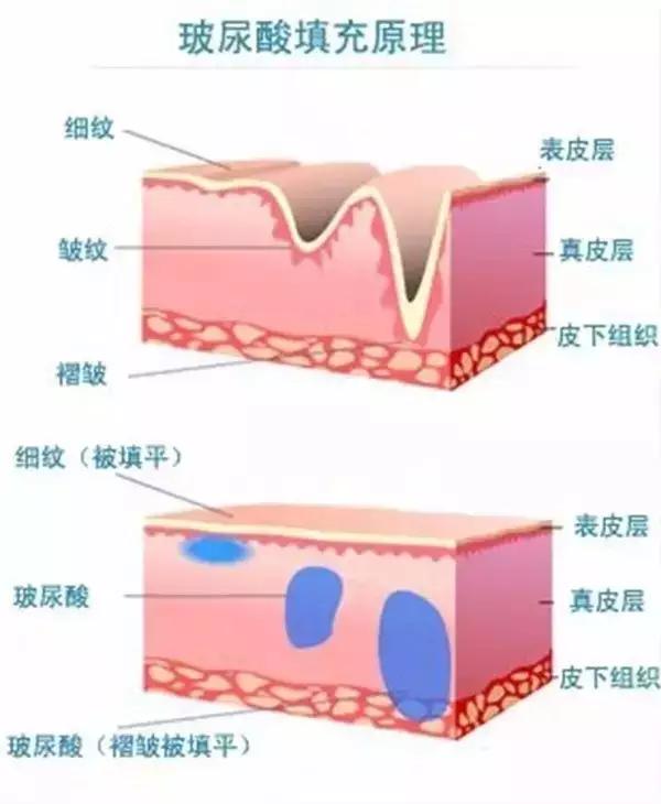 黑眼圈严重怎么办才能彻底去除,黑眼圈严重怎么办快速去除