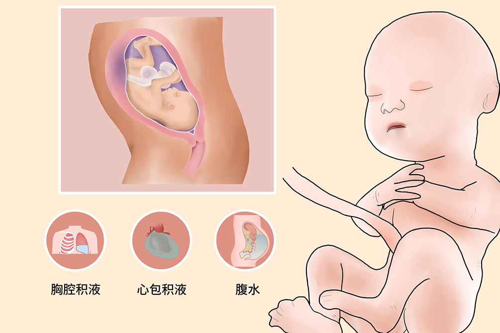 粘多糖贮积症1岁宝宝,黏多糖贮积症多少岁看出来的