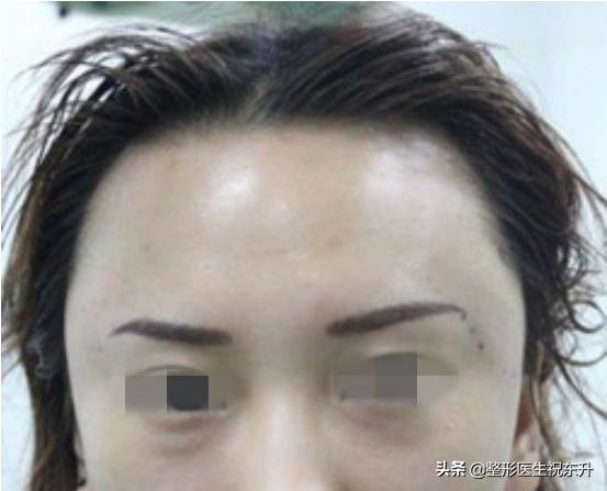 做了额头填充全脸肿怎么办,脂肪填充一年额头填多了怎么办