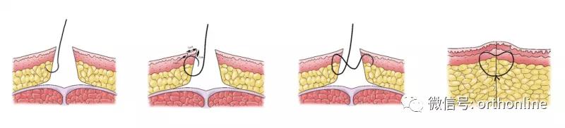 临床清创原则,临床清创
