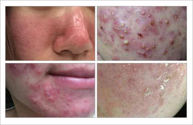 根除脸上螨虫的简单方法,螨虫在脸上如何彻底消除