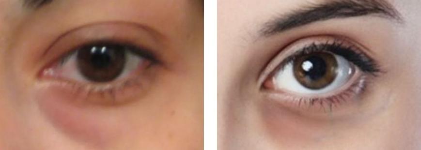 如何改善黑眼圈最有效,黑眼圈是怎么形成的如何淡化