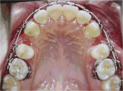 为什么矫正完牙还能反弹呢,为什么矫正完牙齿上门牙还是凸