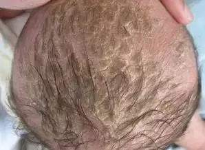 宝宝有脂溢性皮炎可以打预防针吗,脸上脂溢性皮炎最好的治愈方法