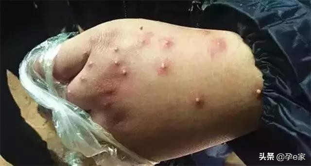 身上出现许多小黑痣,身上出现凸起黑痣一定要重视