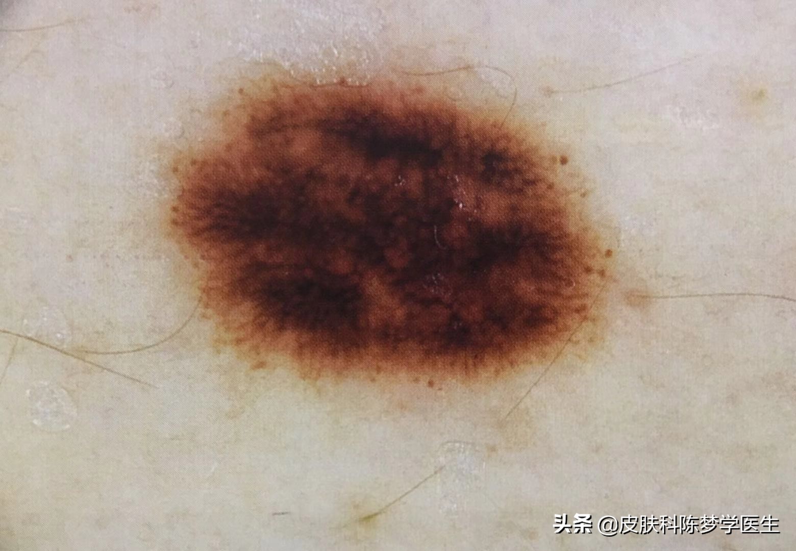 一次激光点痣会导致癌变吗,激光点痣会诱发痣癌变是真的吗