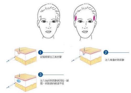 有效去除高颧骨,怎么样才能拯救高颧骨还外扩的脸
