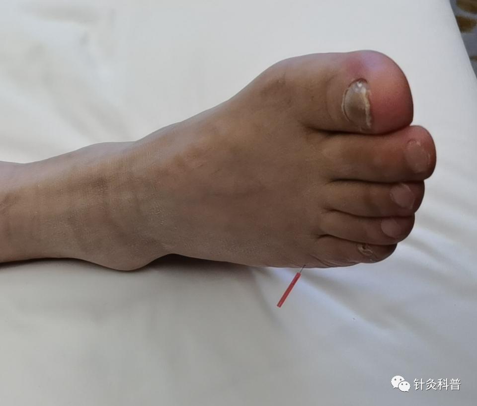 针灸治疗颈椎病视频全集,颈椎病针灸下针手法视频