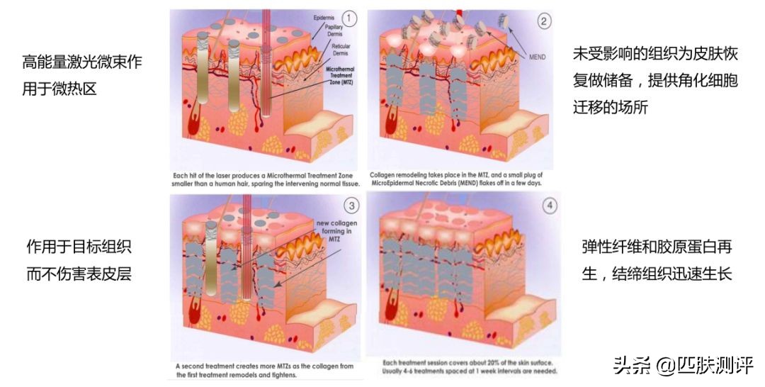 激光美容仪推荐,家用激光美容仪测评
