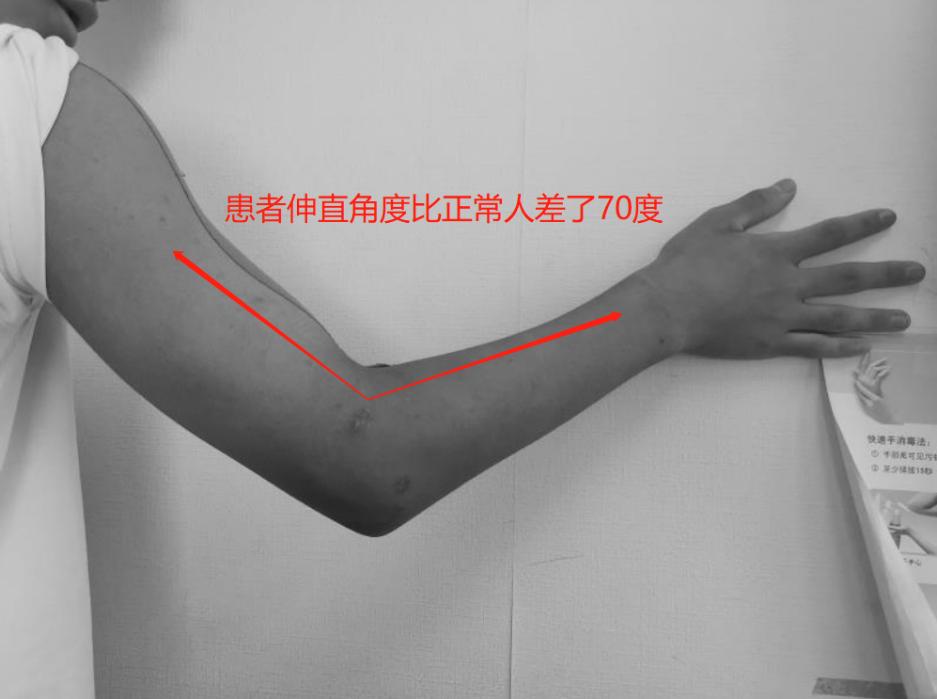 儿童胳膊肘手术后伸不直怎么恢复,手术后胳膊伸不直能恢复正常吗