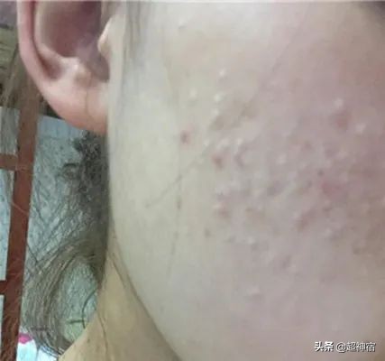 教你5个根治闭口粉刺方法,闭口痘痘彻底根治