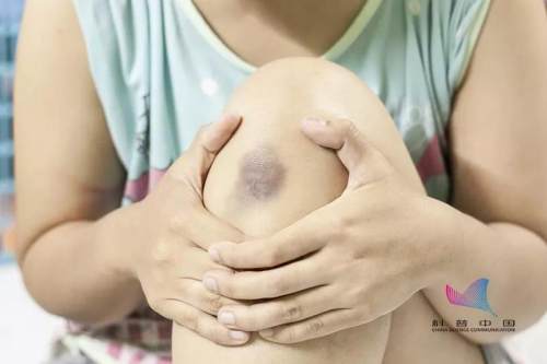 为什么宝宝屁股上有淤青,为什么新生婴儿屁股有黑青