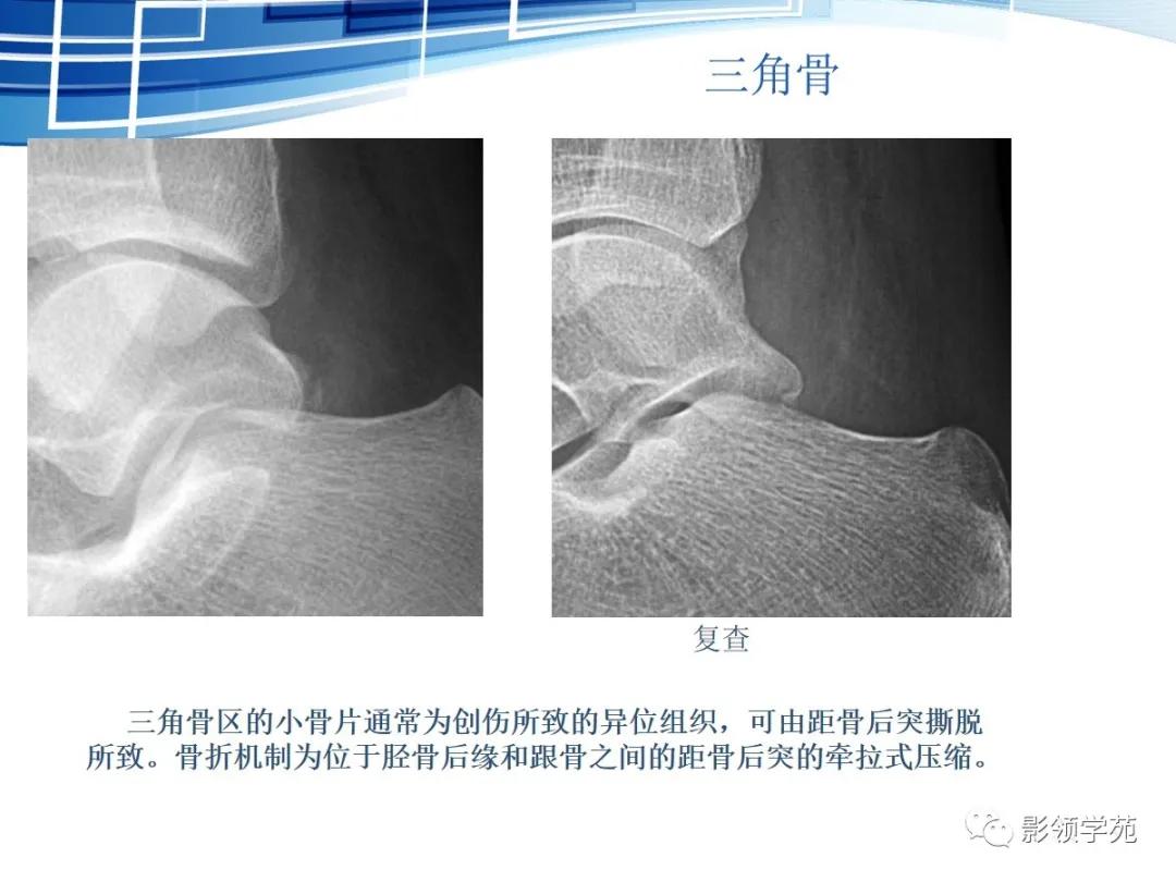 桡骨远端骨折引起尺骨变异,撕脱骨折一个月无明显骨痂形成