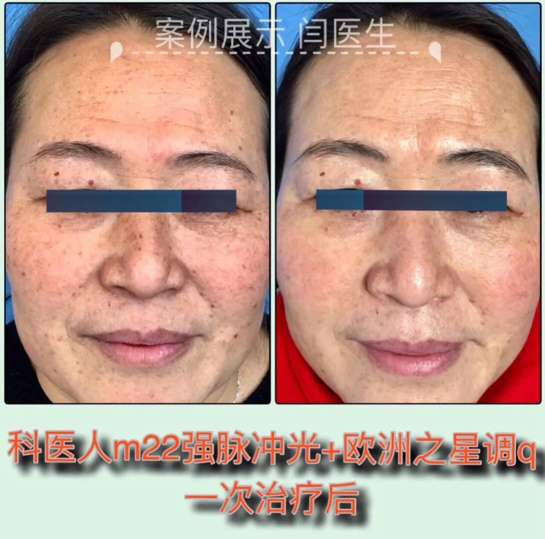 雀斑一扫而光,雀斑怎么才能让它变淡