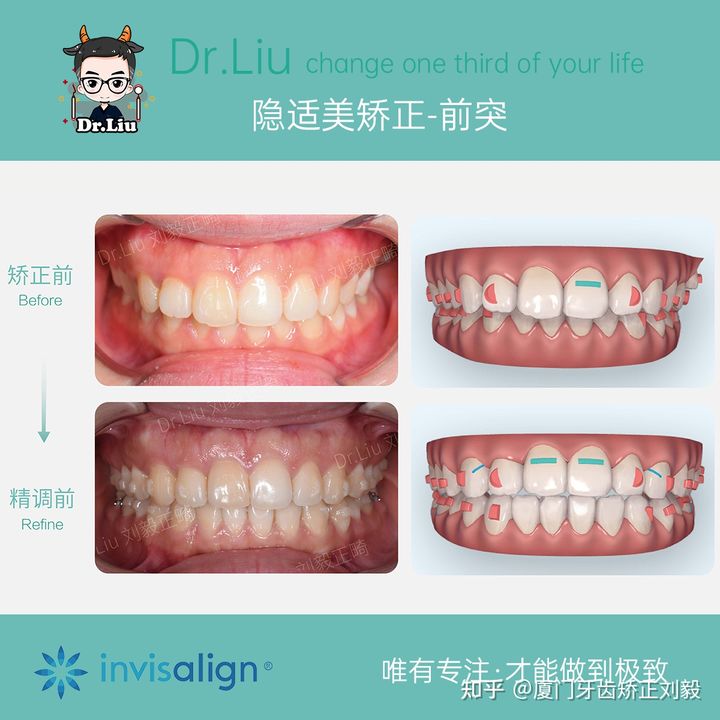 正畸临床拔牙矫治,拔牙正畸矫正嘴凸案例