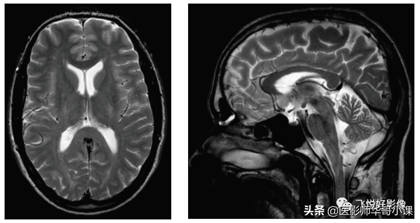 飞利浦磁共振序列参数解读,飞利浦磁共振波谱成像扫描技术