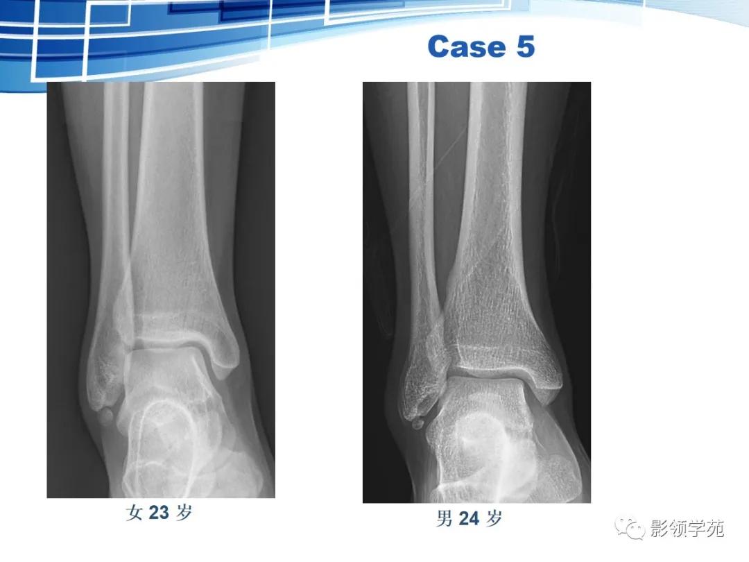 桡骨远端骨折引起尺骨变异,撕脱骨折一个月无明显骨痂形成