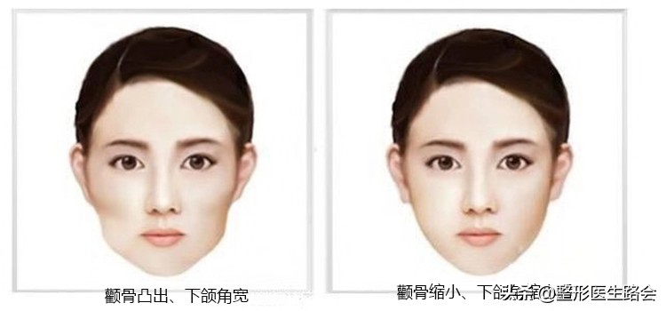 颧骨内推和填充玻尿酸哪个好,太阳穴凹陷颧骨突出填充还是内推