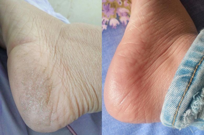 冬天脚后跟干裂用什么润脚霜,润足脚后跟干裂修复霜