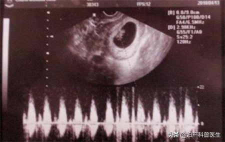 孕期B超检查做多了会引起胎儿畸形?做几次合适,需要注意什么?