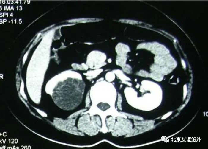 体检发现肾囊肿需不需要做手术,儿童体检发现肾囊肿