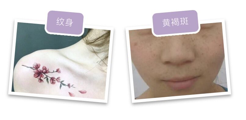 追求素颜肌必做项目之光子嫩肤——做之前需要知道的那些事