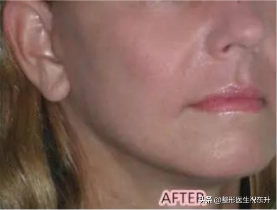 线雕后脸变宽眼睛变小了,线雕后脸变宽了多久能恢复