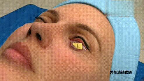 眼袋手术后真的显年轻吗,割眼袋能年轻几岁