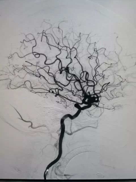 Tubridge®治疗多发性动脉瘤