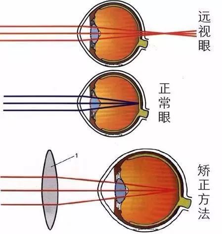 孩子远视1000度能看多远,远视加弱视1000多度能治好吗