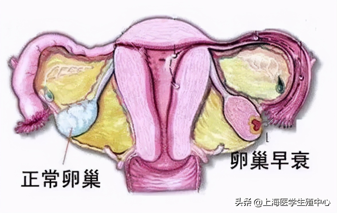 试管婴儿取完卵防止腹水,试管婴儿取完卵怎么调养身体
