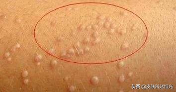 得了扁平疣如何锻炼身体,扁平疣是很严重的疾病吗