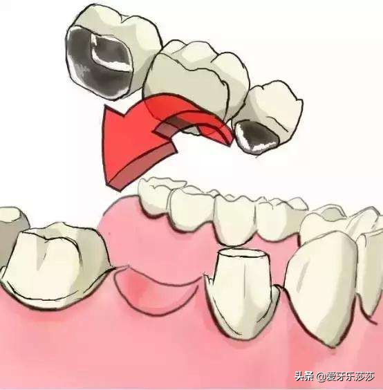成人戴烤瓷冠能牙齿矫正吗,烤瓷冠牙齿矫正