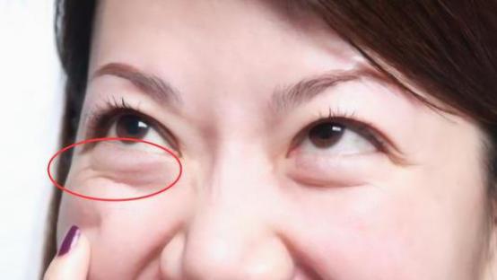 29分钟快速祛眼袋,女士微创去眼袋