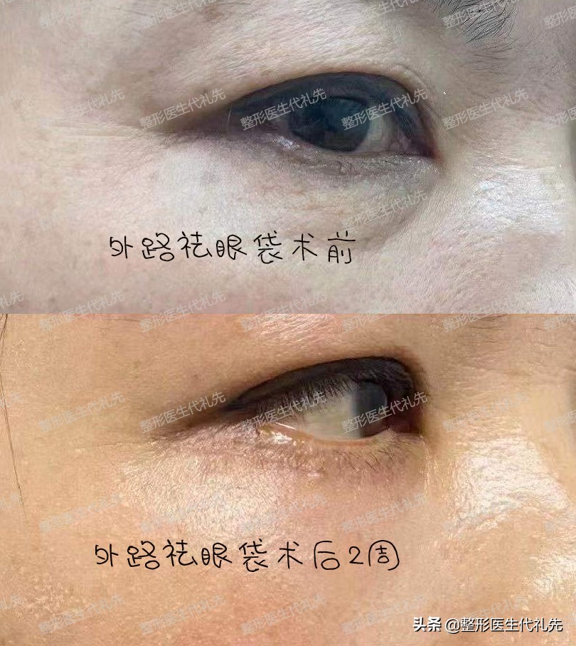 祛眼袋眼睑轻度外翻悬吊多久能好,外切口去眼袋面部提升能维持多久