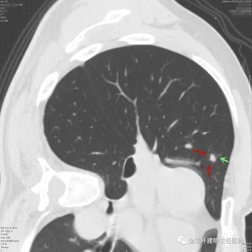 叶建明谈胸膜下的实性结节,叶建明肺实性良性结节会变癌症吗