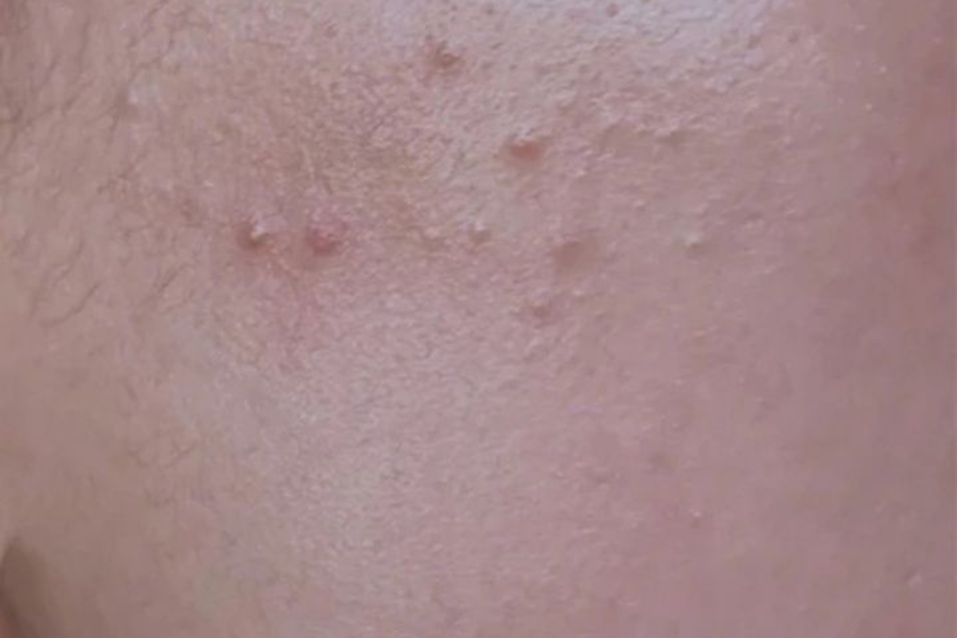 脸上的小疙瘩看得出来吗,脸上的小疙瘩是角质层吗