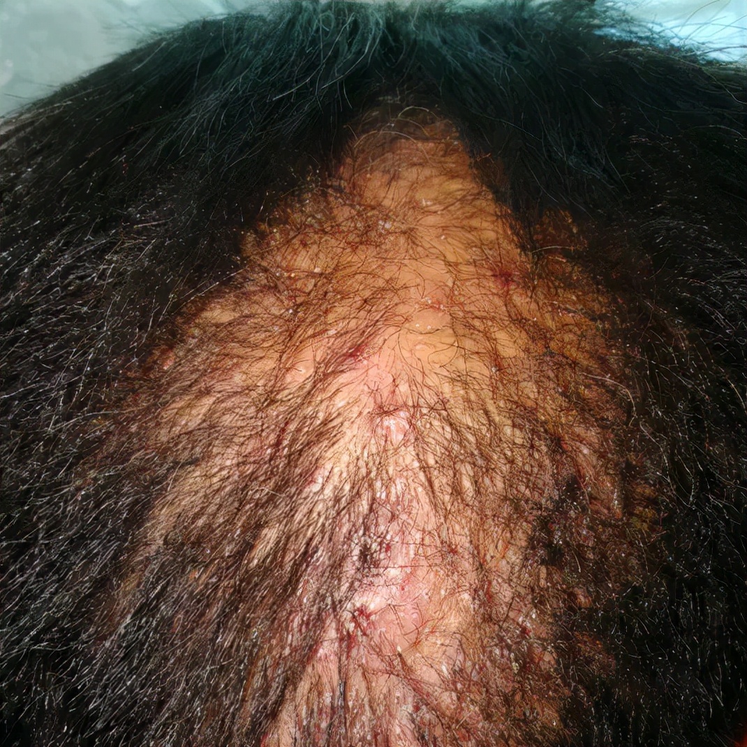 靶向药引起皮肤溃烂擦什么药膏好,靶向药导致的皮肤毒性该怎么治疗